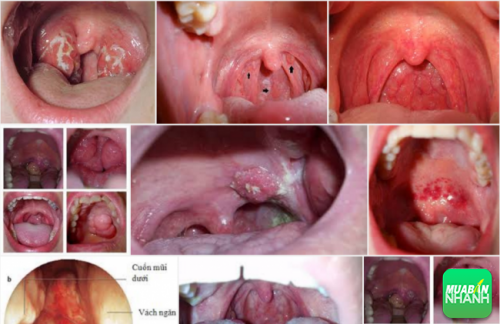 Ung thư vòm họng đang trở thành căn bệnh phổ biến hiện nay 