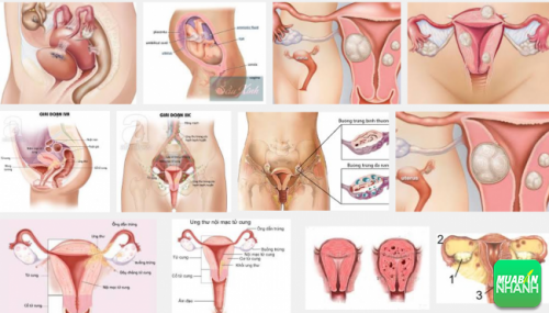 U lạc nội mạc tử cung là căn bệnh phụ khoa phụ nữ rát lo sợ