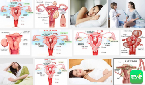 U xơ tử cung là căn bệnh thường mắc phải của chị em phụ nữ