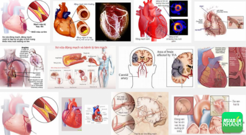 Bệnh tim thiếu máu cục bộ có nhiều triệu chứng khác nhau