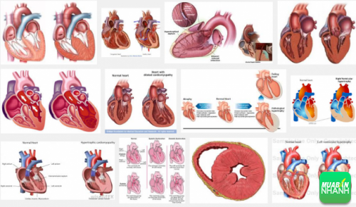 Bệnh cơ tim phì đại là một căn bệnh trong đó cơ tim trở nên phì đại nở to bất thường. 