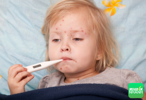 Thủy đậu ở trẻ em nếu không được chữa trị sẽ gây ra nhiều biến chứng