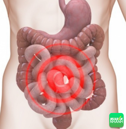 Hội chứng ruột kích thích thường có triệu chứng đau bụng, táo bón,...gây trở ngại trong sinh hoạt