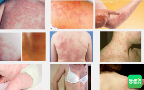 Dị ứng gây ra những tổn thương bề mặt da, khiến người bệnh đau rát