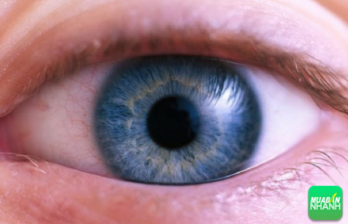 Mắt của bệnh nhân bị Glaucoma