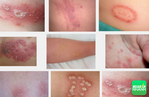 Vết thương do kiến ba khoang gây ra cần được xử lý đúng cách để không tổn hại da sau này