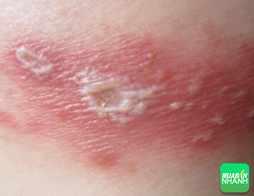 Nếu bị kiến ba khoang đốt người bệnh rất dễ bị viêm da.