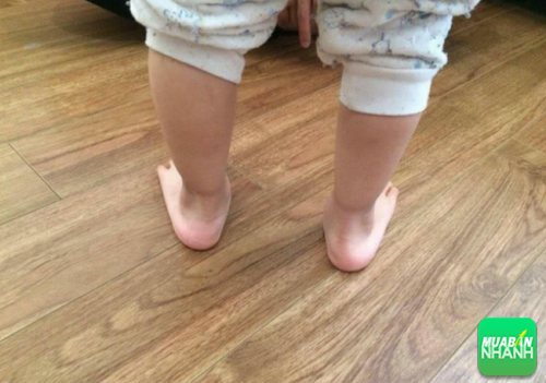 Hình ảnh chân của bé Tuva, hai má bàn chân đổ vào trong.