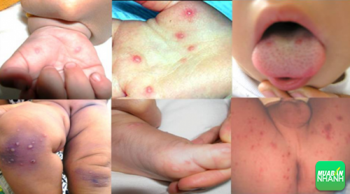 Bệnh tay - chân - miệng diễn ra phổ biến ở trẻ em dưới 5 tuổi.