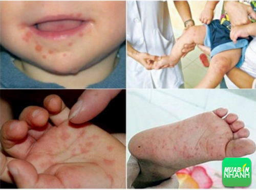 Bệnh tay - chân - miệng đang trở nên phổ biến ở trẻ em
