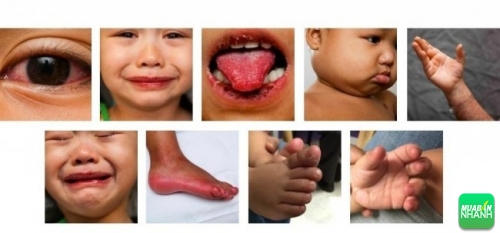 Biểu hiện bệnh Kawasaki ở trẻ em dễ nhầm lẫn với nhiều bệnh khác.