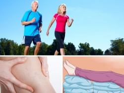 Phương pháp ngăn ngừa bệnh suy giãm tĩnh mạch chân đến với bạn