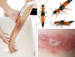 Cần làm gì để xử lý tổn thương do kiến ba khoang đốt