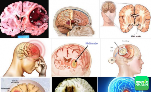 Phát hiện sớm ung thư não qua các biểu hiện, 37, Phương Thảo, Cẩm Nang Sức Khỏe, 21/09/2016 11:56:46